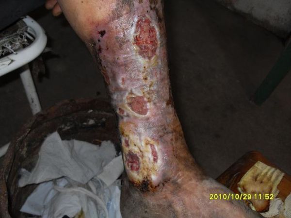 梦到腿腐烂是什么意思_腿腐烂梦境预示什么