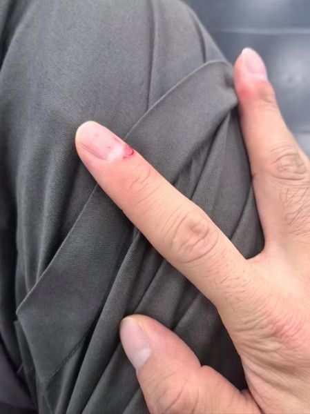 梦到手指受伤是什么意思_梦到手指受伤预示什么