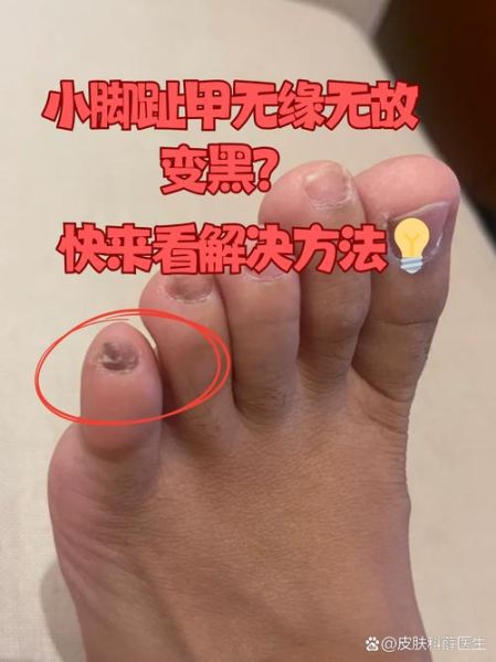 梦到趾甲盖脱落_梦到趾甲盖变黑是什么意思