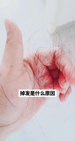 梦到掉头发是什么预兆_梦见脱发严重怎么办