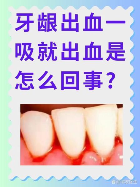 梦到牙齿出血是什么意思_梦到牙齿出血预示着什么