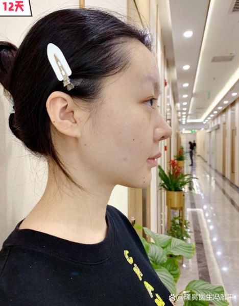 隆鼻后财运会好吗_隆鼻真的会影响运势吗