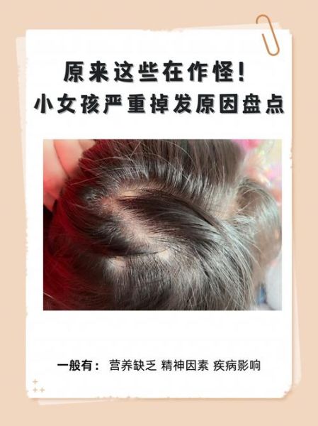 梦到孩子掉头发是什么预兆_孩子掉头发梦境解析