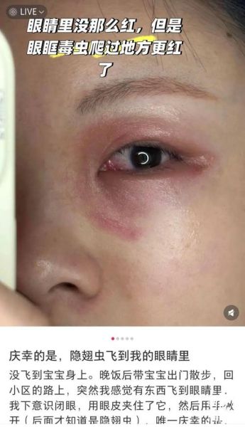 梦到脸被烧伤_预示什么