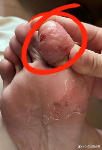 梦到脚上长疮_代表什么预兆