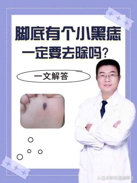 脚底有痣代表什么_脚底点财运痣图解