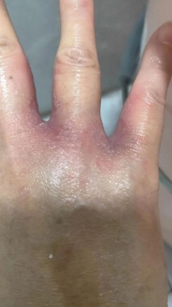 梦到手烂是什么意思_梦见手烂掉预示什么