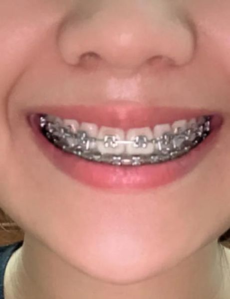 梦到摘牙套是什么意思_梦到摘牙套预示什么