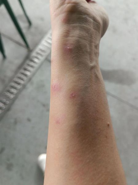 梦到被虫子咬出血_梦见虫子咬出血什么意思