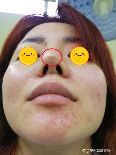 整鼻子会影响财运吗_隆鼻后运势变化