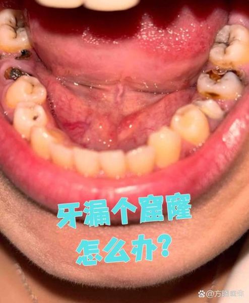 梦到蛀牙碎了_是什么预兆