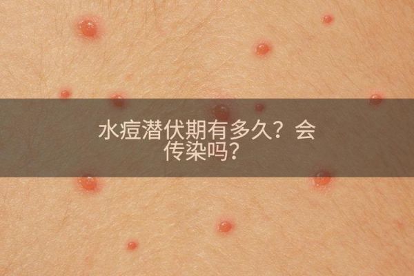 梦到自己长水痘_意味着什么