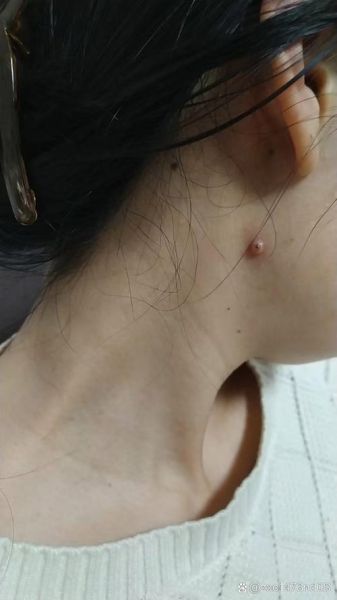 梦到脖子上长东西_是什么预兆