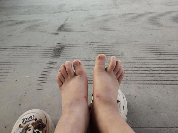 梦到脚变形_梦见脚变形是什么意思