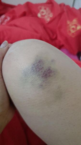 梦到老公摔伤了_是什么意思