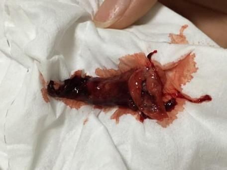 梦见流产是什么意思_梦见流产是胎梦吗