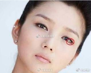 眼白有痣财运_眼白痣影响财富吗