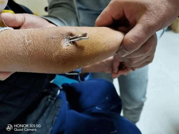 梦见自己开刀做手术_是什么预兆