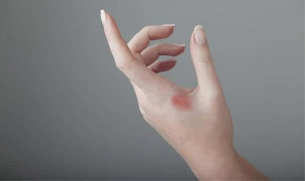 梦到手烧伤_梦见手被烫伤预示什么