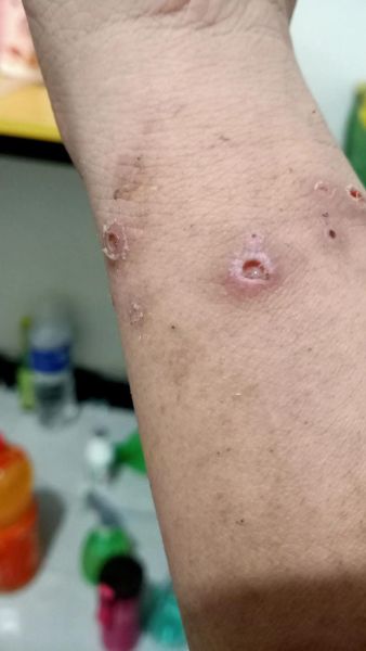 梦到别人身上长疮_是什么意思